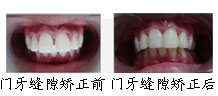 牙齿矫正前后对比图
