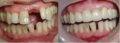 前牙种植术前后注意事项有哪些