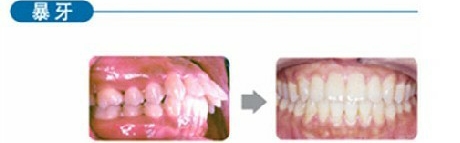 轻微龅牙怎么治疗好