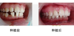 老人牙齿脱落怎么办