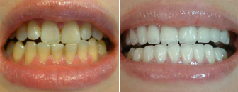 牙黄是什么原因导致的