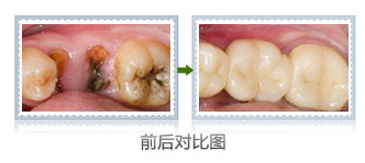 补一颗虫牙多少钱