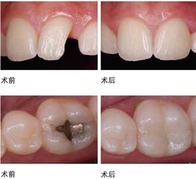 成人蛀牙怎么办