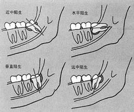 智齿龋坏了怎么办