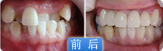 儿童牙齿矫正也要拔牙吗